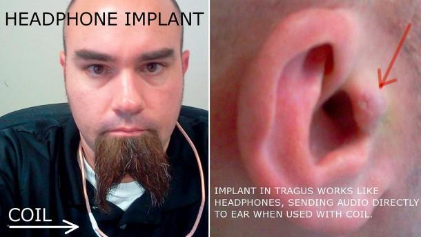 Rich Lee and his implant 2