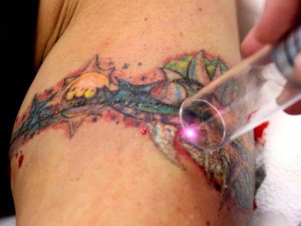  Get Rid Off Your Tattoo In Using Modern Laser Technology