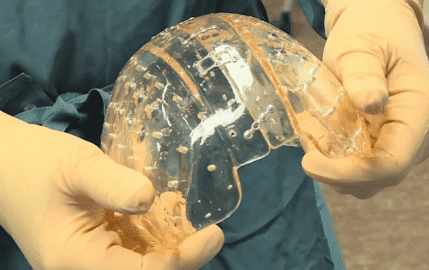 3D printed cranial Implant 3