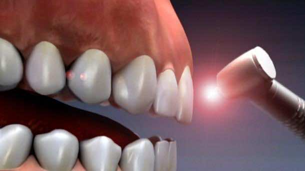 Laser and Dental 7
