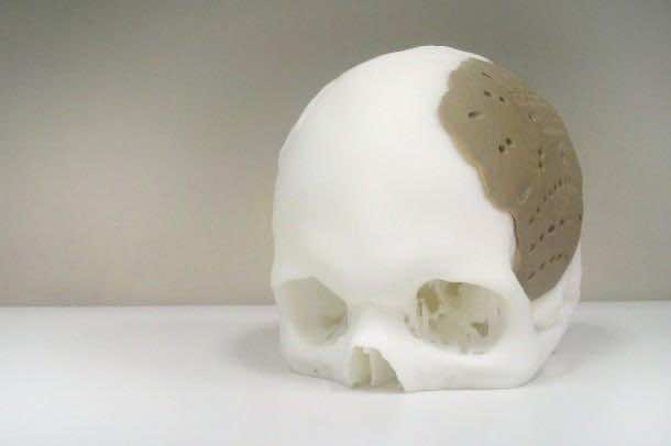 FDA Approves 3D Printed Face Implant