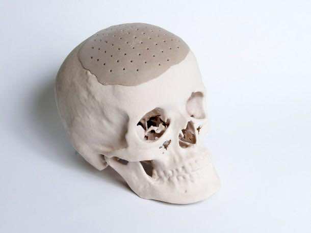 FDA Approves 3D Printed Face Implant4