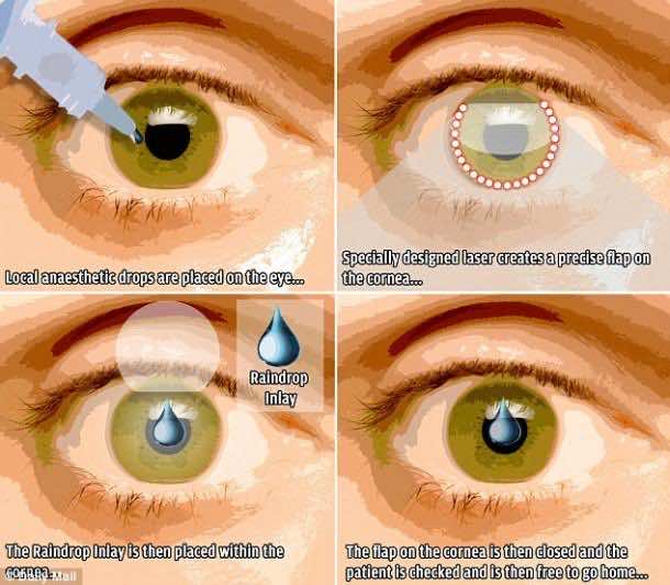 Raindrop Implant to Cure Near-Medium Vision