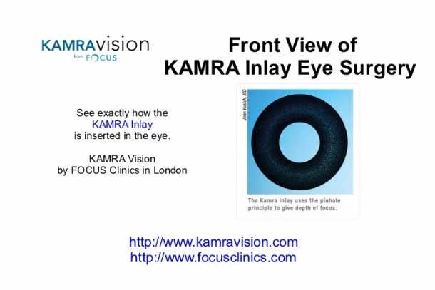 Get Rid of Presbyopia – Kamra Inlay4