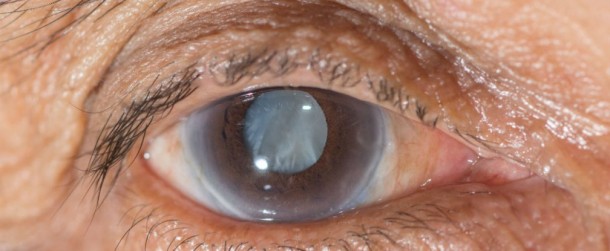 Eye Drops Are The Alternative To Cataract Surgery 2