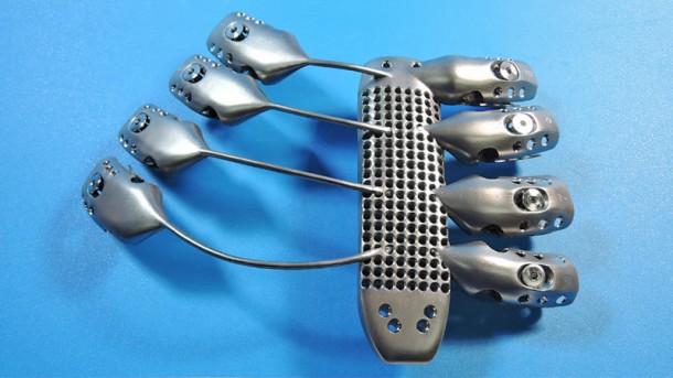 Patient Suffering From Cancer Received World’s First 3D Printed Rib Cage 2