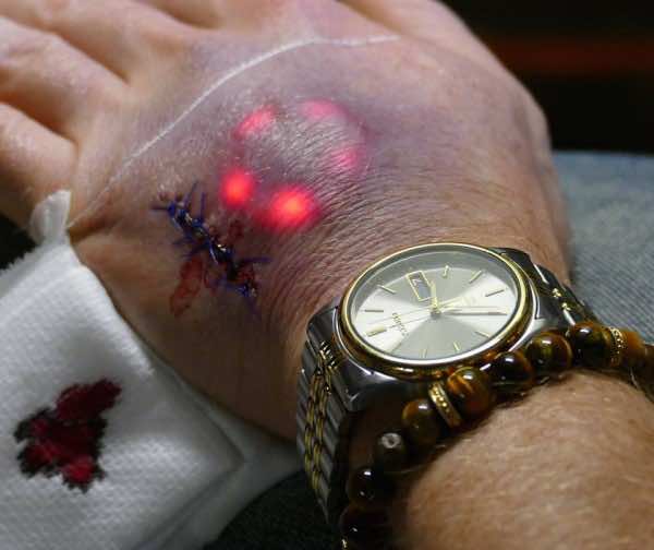 Implanting LED Lights Under Your Skin Is The Latest Biohacking Trend 2