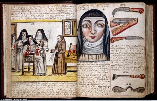 This Is How Surgeries Were Done In 17th Century When Anesthesia Was Not Invented Yet 10