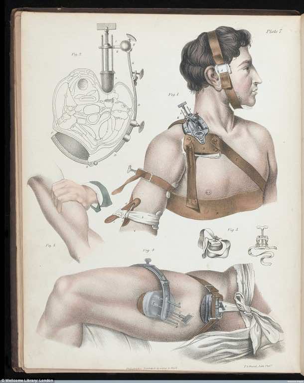 This Is How Surgeries Were Done In 17th Century When Anesthesia Was Not Invented Yet 11