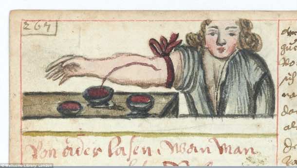 This Is How Surgeries Were Done In 17th Century When Anesthesia Was Not Invented Yet 15