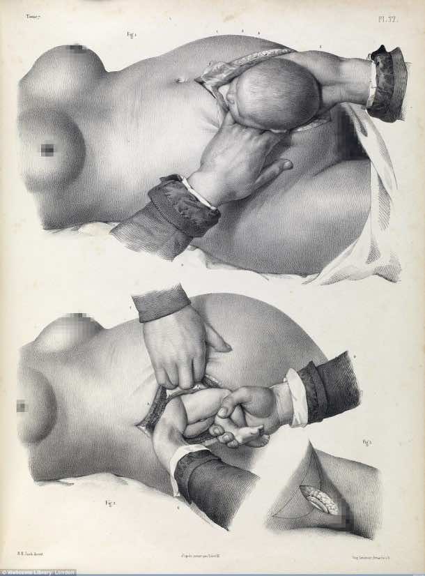 This Is How Surgeries Were Done In 17th Century When Anesthesia Was Not Invented Yet 4