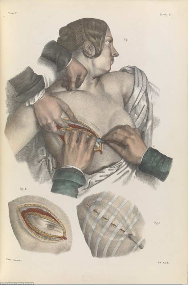 This Is How Surgeries Were Done In 17th Century When Anesthesia Was Not Invented Yet 5