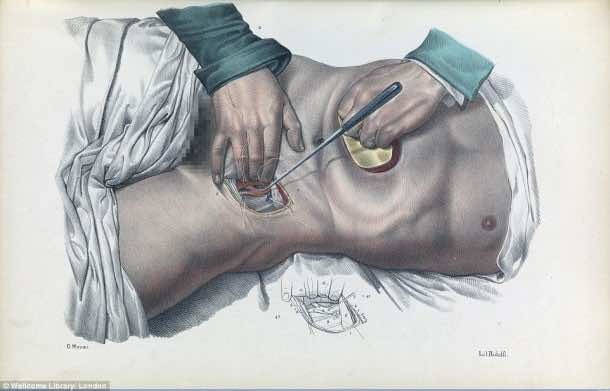This Is How Surgeries Were Done In 17th Century When Anesthesia Was Not Invented Yet 7