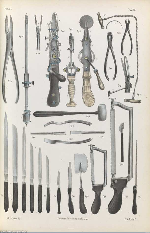 This Is How Surgeries Were Done In 17th Century When Anesthesia Was Not Invented Yet 9