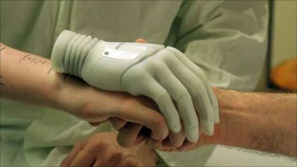 Milo is measured up using his bionic hand prior to the operation. Credits: bbc.com