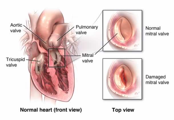 Anterior cut view of heart. Healthy and damaged mitral valve shown. Credits: vhcphysiciangroup.com