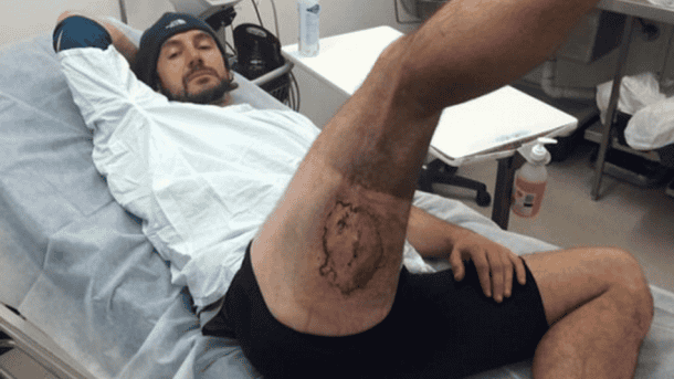An iPhone Allegedly Exploded In His Pants And Left Third-Degree Burns On His Butt_Image 0