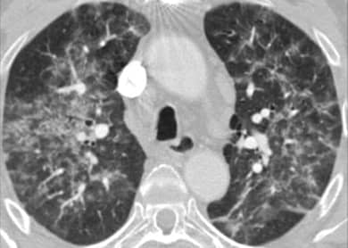 CT scan of inflamed lungs of a patient suffering form HP. Credits: M. Funke, J-M. Fellrath/European Respiratory Journal.