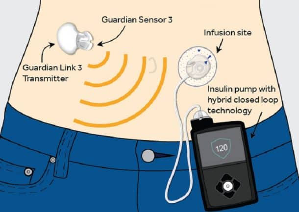 finally-the-worlds-first-artificial-pancreas-just-got-approved_image-0