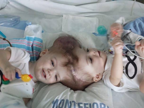 the-american-surgeons-successfully-separate-13-month-old-twin-boys-conjoined-at-head_image-0