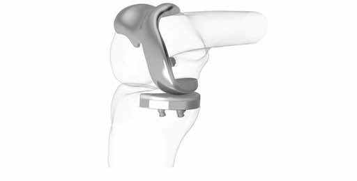 Knee Replacement 3D Printing conforMIS5