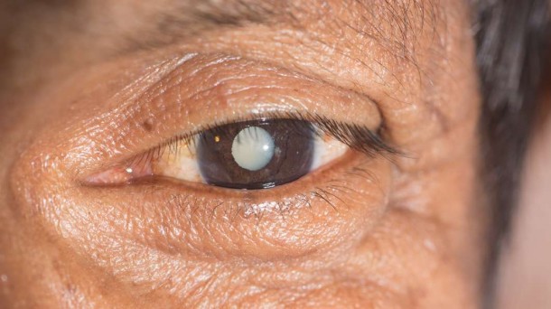 A new alternative to cataract surgery
