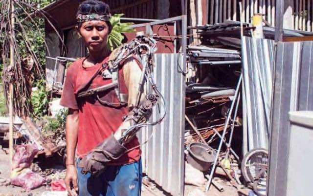 Indonesian Guy Bionic Limb