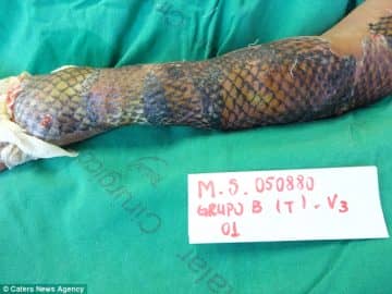 Brazil Doctors Are Using Fish Skin To Treat Burn Victims In A