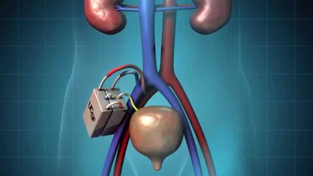 this-artificial-kidney-eliminates-the-need-for-kidney-dialysis