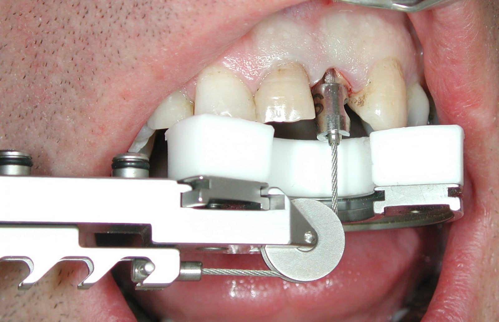 tooth extractor tool
