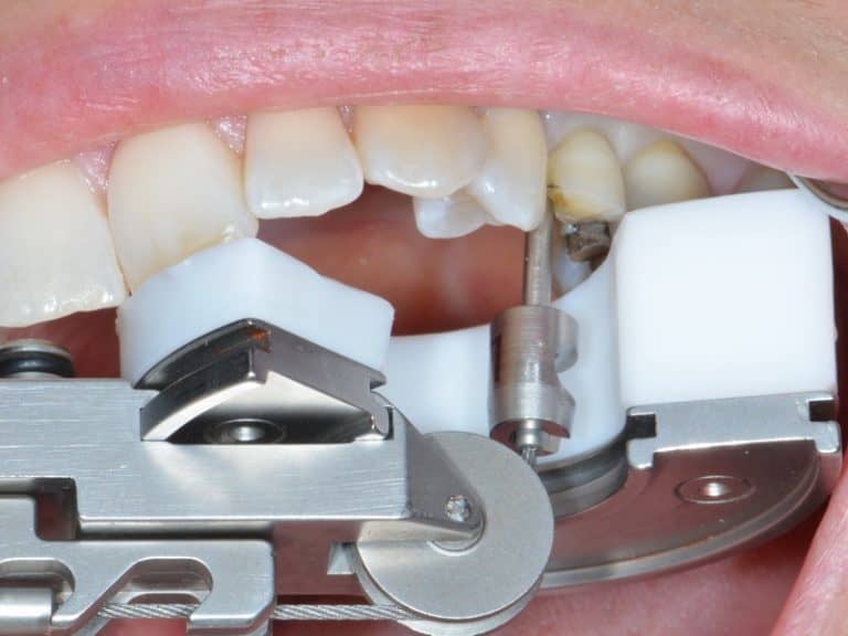 This New Dental Tool Is The Solution To All The Painful Tooth Extractions