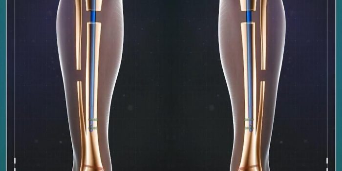 Reddit surgery leg lengthening Limb