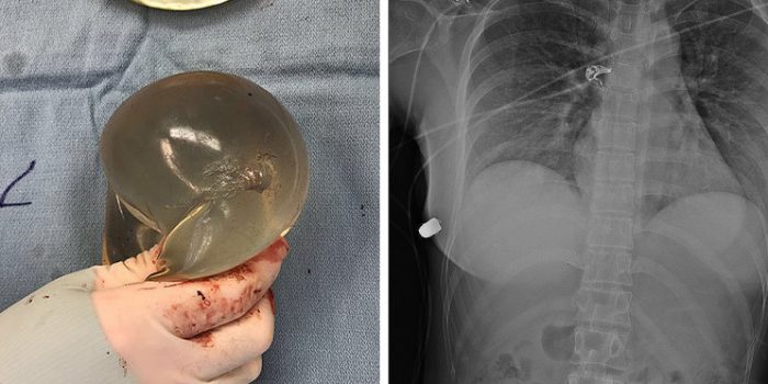 This Woman’s Life Was Saved By Her Breast Implants After A Gunshot
