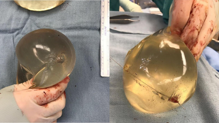 This Woman’s Life Was Saved By Her Breast Implants After A Gunshot