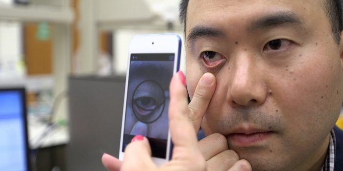 This App Can Detect Signs Of Anemia Using Your Smartphone
