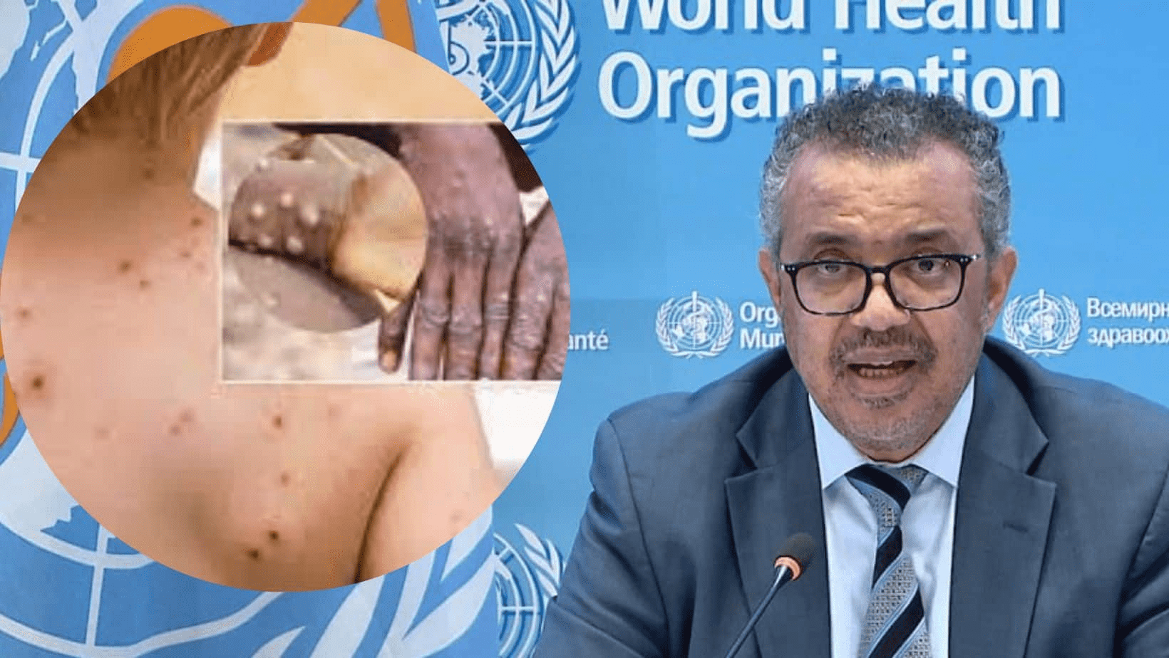 the-who-has-declared-monkeypox-as-a-global-health-emergency