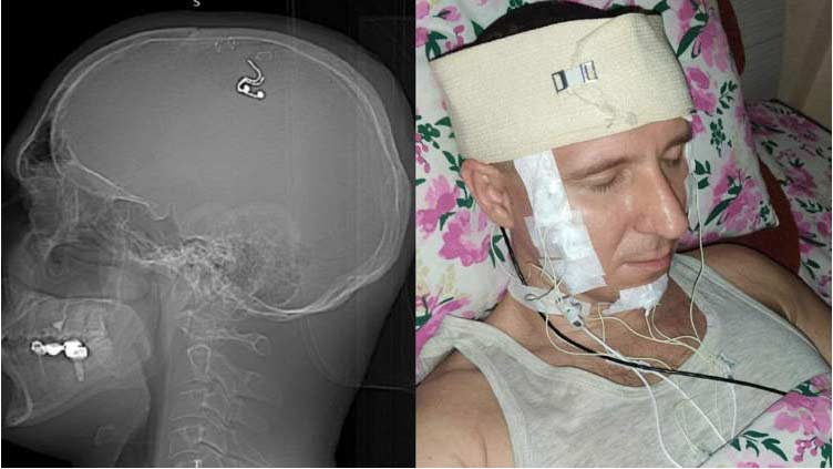 This Russian Scientist Claims To Have Performed A Brain Surg